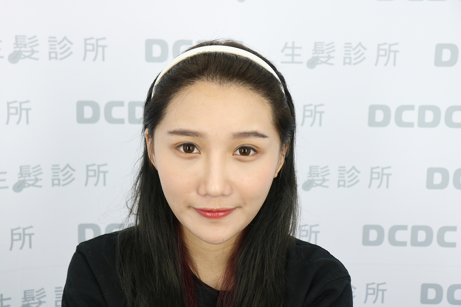 DCDC植髮診所-方孝俤醫師美型植髮術後一年蓬鬆自然成果
